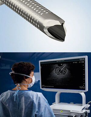 Olympus Announces U.S. Launch of the SecureFlex™ Single-Use Fine Needle Biopsy Device